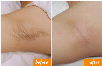 石家庄怎么样脱腋毛更好