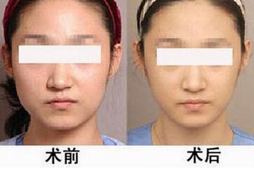 石家庄星源注射瘦脸针真人对比案例