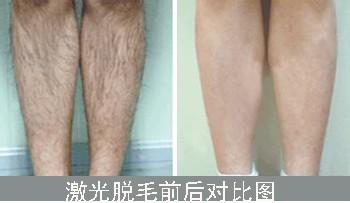 星源激光脱毛对比图