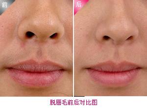激光脱唇毛前后对比