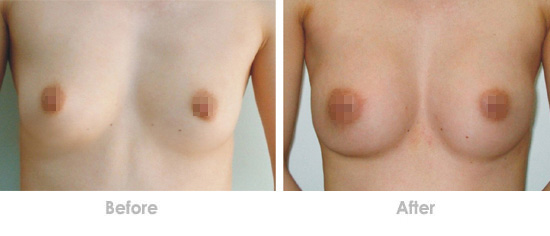 ʯ¼ÒׯÐÇÔ´¼ÙÌå·áÐØÐ§¹û¶Ô±Èͼ