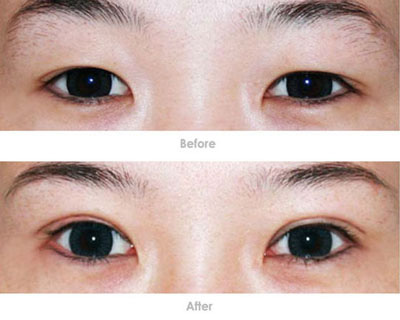 石家庄星源割双眼皮效果对比图