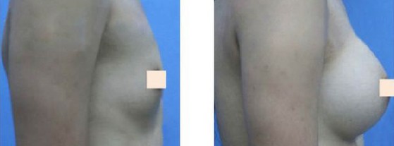 石家庄星源隆胸真人对比案例