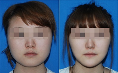 看看我吸脂前后的对比照片吧