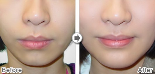 星源自体脂肪隆下巴前后对比图