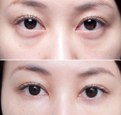 星源祛眼袋效果对比图