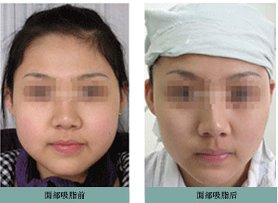 术前术后对比效果