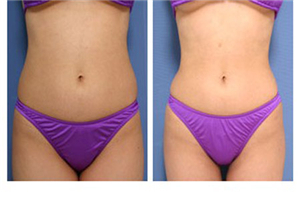 星源吸脂瘦身效果对比图