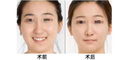 吸脂瘦下巴前后对比
