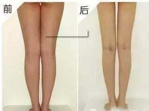 吸脂瘦腿前后对比
