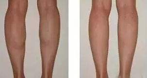 肉毒素瘦腿前后对比