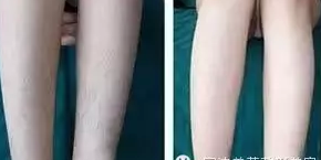 脱毛前后对比