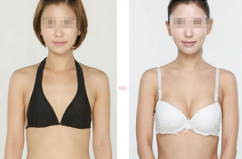 星源隆胸效果对比图