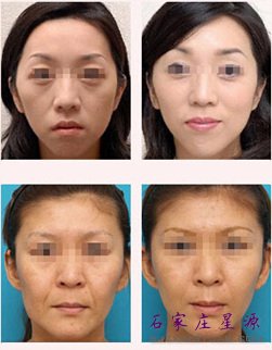 胶原蛋白除皱效果不错