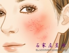 激光去除面部红血丝价格