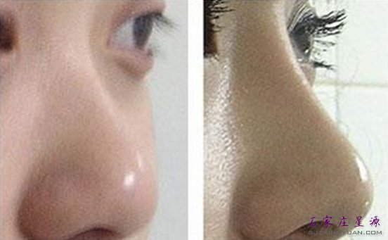 假体打造高挺美鼻