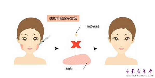 注射瘦脸针的原理 如图示