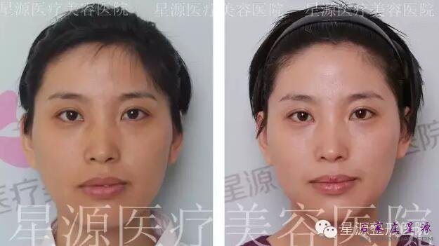 ��������ɯ��ʹˮ���� ����ǰ��Ч���Ա�