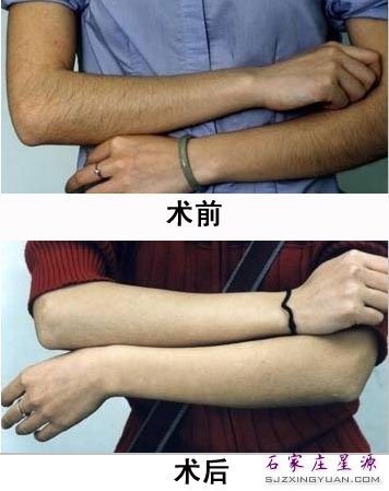 激光快速祛除多余毛发