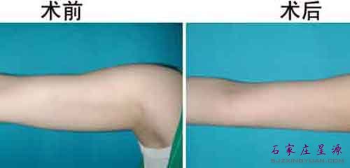 手臂吸脂价钱比较合理