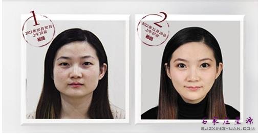 做完改脸型和双眼皮之后的杨昆已经非常漂亮了