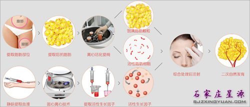 自体脂肪丰额头 塑造饱满旺夫相
