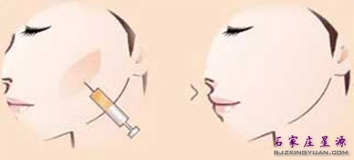 注射填充 打造轻盈苹果肌