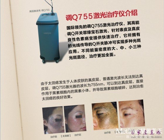 星源赛诺秀调Q755治疗太田痣更彻底