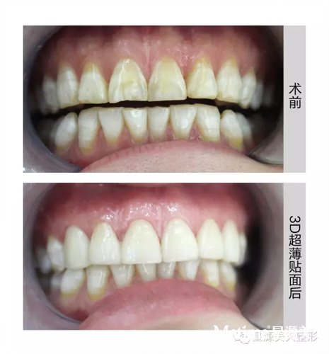 (6颗前牙)3D超薄贴面 前后对比