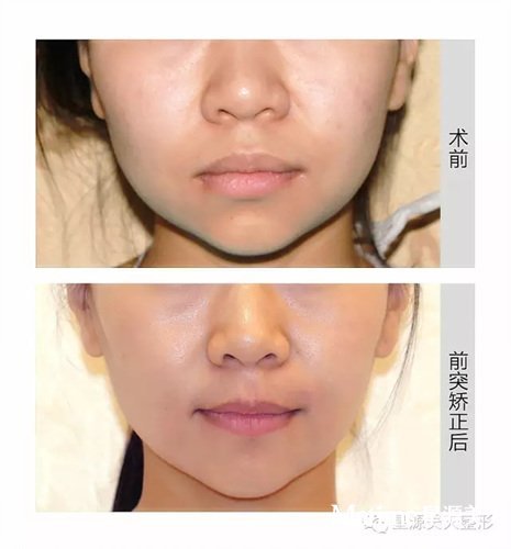 胡谦主任牙齿前突矫正前后对比