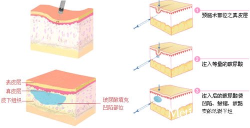 玻尿酸注射效果