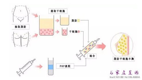自体脂肪隆胸