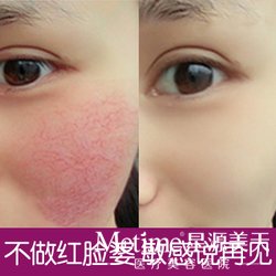 如何治疗脸上的红血丝