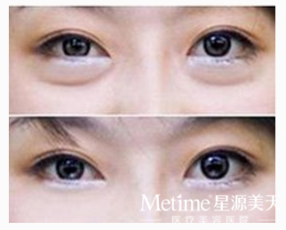 长期上夜班导致眼袋比较大怎么办