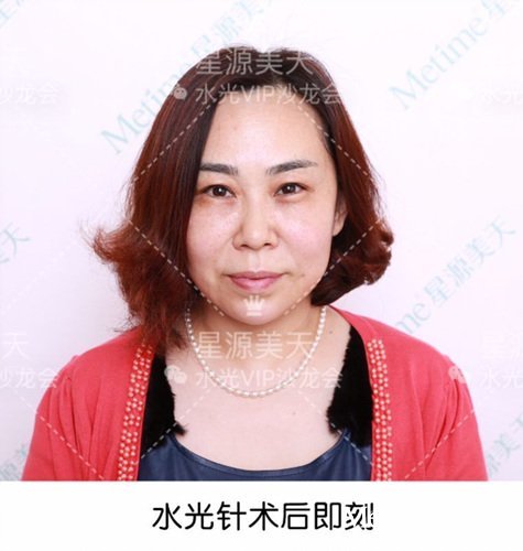 模特术后效果即现