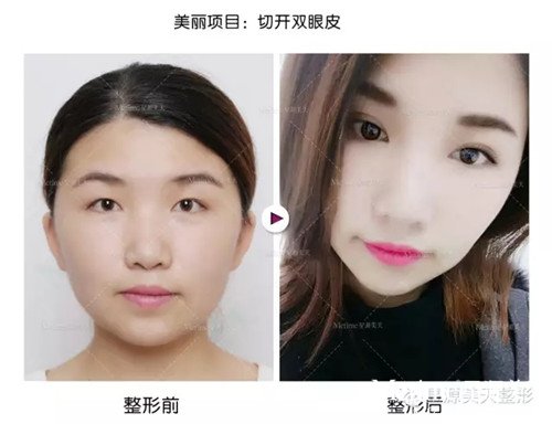 双眼皮术后护理
