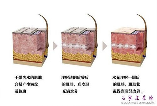 注射玻尿酸