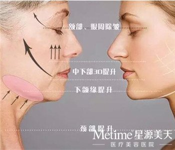 石家庄PDO蛋白线提升哪家医院好?