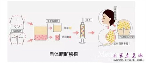 自体脂肪填充原理 如图示