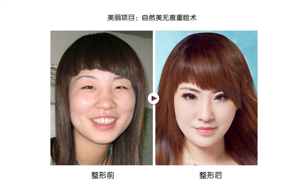 单眼皮如何变双眼皮