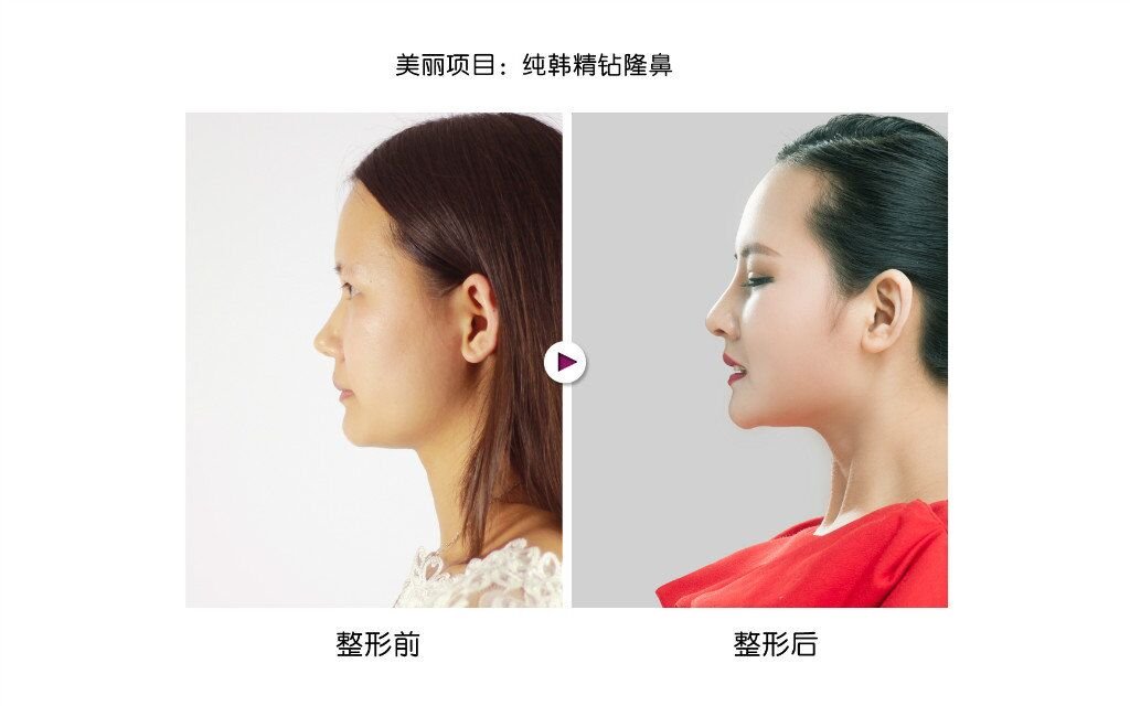 注射隆鼻效果维持时间