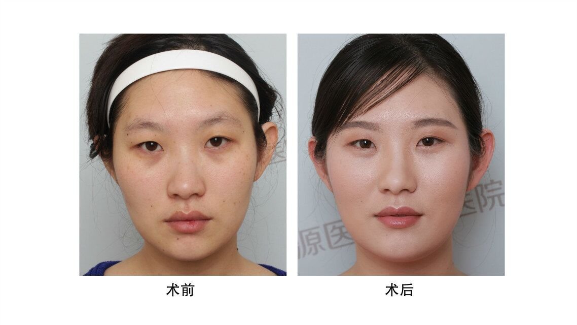 刚刚注射完水光针脸会肿吗