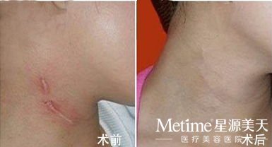 身体有疤痕怎么治疗好