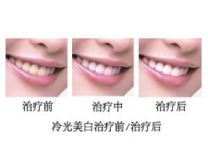 冷光美白的治疗过程