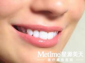 牙齿贴面价格不是固定的