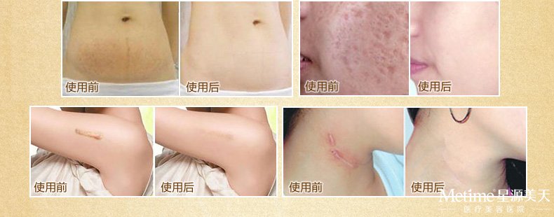 简单去疤痕的方法