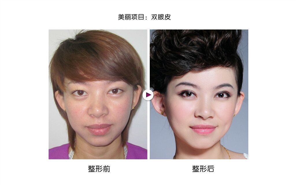 星源美天埋线双眼皮