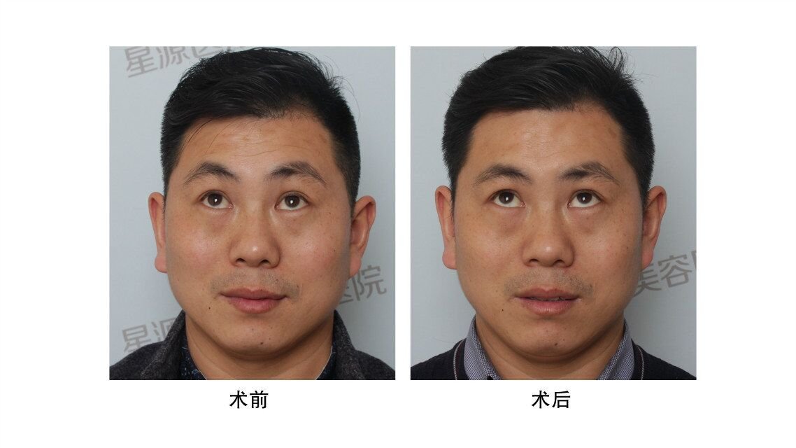 30岁抬头纹特别明显怎么办