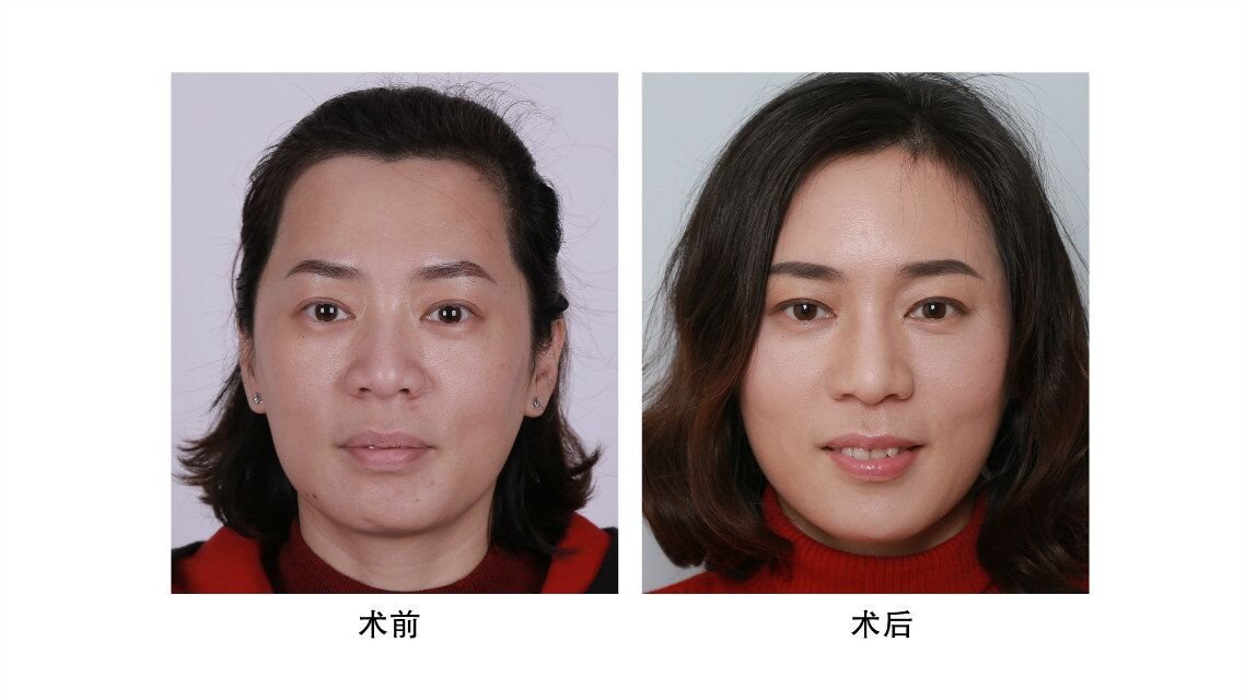 脸颊凹陷怎么办
