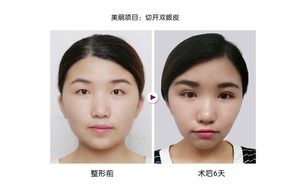 做埋线双眼皮疼吗
